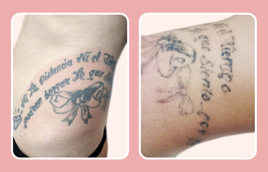 fotos antes y después laser para tatuajes